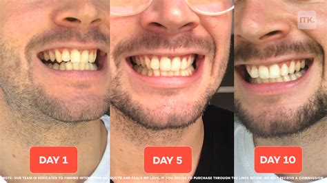 We tried Colgate's latest teeth whitening device that claims to whiten teeth by 6 shades in 10 days