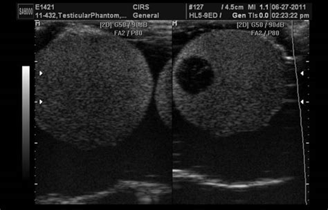 Scrotal Ultrasound | Best Urologists in Forest Hills, Queens, NY | Medex - Multi-Specialty ...