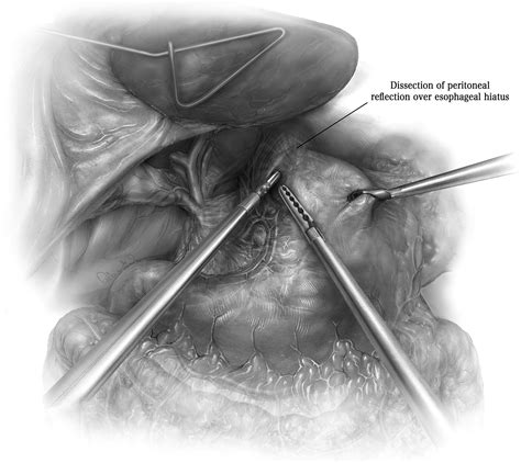 Laparoscopic Heller Myotomy for Achalasia - Operative Techniques in ...