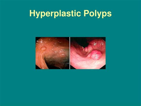 Hyperplastic Polyp