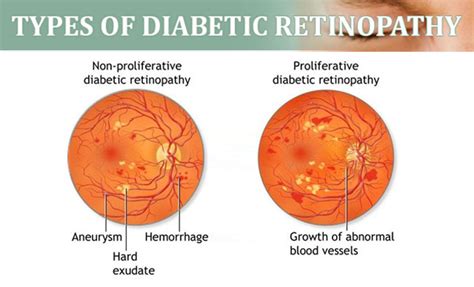 Diabetic Retinopathy - Women Fitness