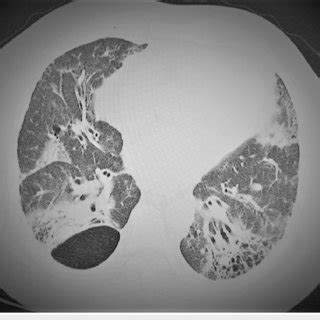 Chest CT scan: lung parenchyma window showing architectural distortion ...