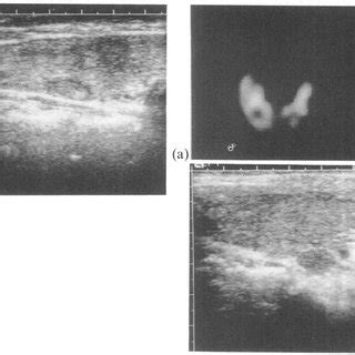 Patient MC with multinodular goitre: ultrasound (a) shows small nodules... | Download Scientific ...