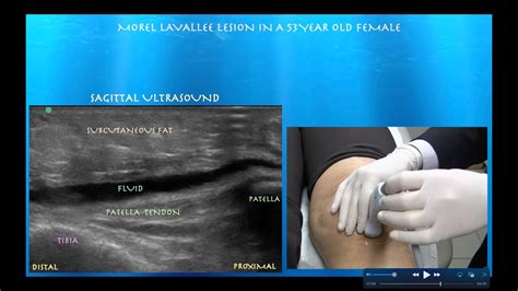 Ultrasound Guided Aspiration/Injection of a Morel Lavallee Lesion of the Knee - YouTube