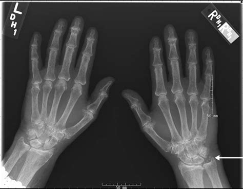 Gout Vs Pseudogout Crystals