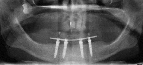 Final panoramic radiograph. | Download Scientific Diagram