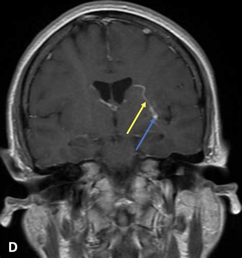 Cavernous Malformation (CM) - MRI Online