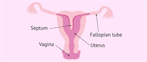 Diagram of a septate uterus