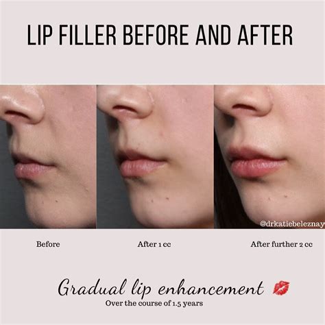 Lip Filler and Gradual Lip Enhancement — Dr. Katie Beleznay