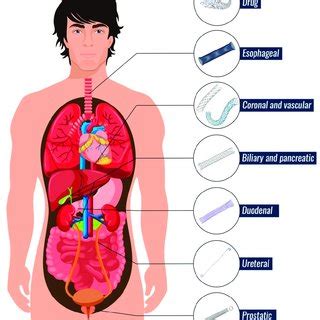 Types of biliary stents. | Download Scientific Diagram