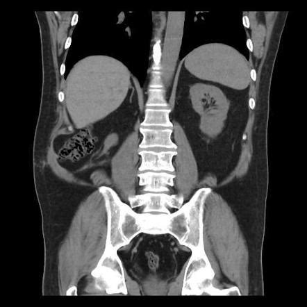 Secondary acquired lumbar hernia - superior lumbar triangle | Radiology ...