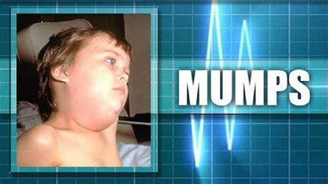 Mumps outbreak reported in Garfield County | KTUL