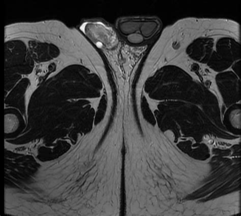 Epididymal head cyst - wikidoc