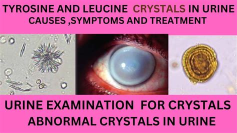 TYROSINE AND LEUCINE CRYSTALS IN URINE.CAUSES ,SYMPTOMS AND TREATMENT ...