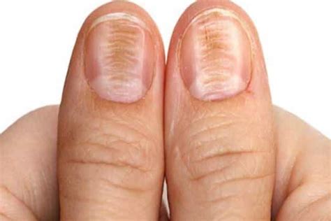 Ridges in Fingernails, Beau's, Lines, Horizontal, Vertical, Pictures, Causes, Treatment & Home ...