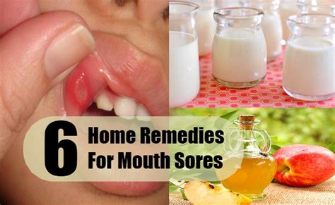 6 Home Remedies For Mouth Sores | Search Home Remedy