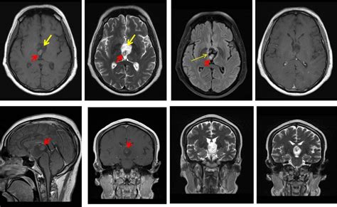 Craniopharyngioma – Radiology Cases