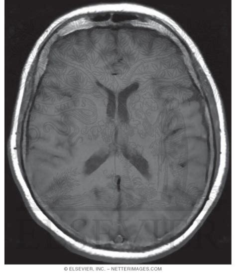 T1 Axial MRI Through the Lateral Ventricles