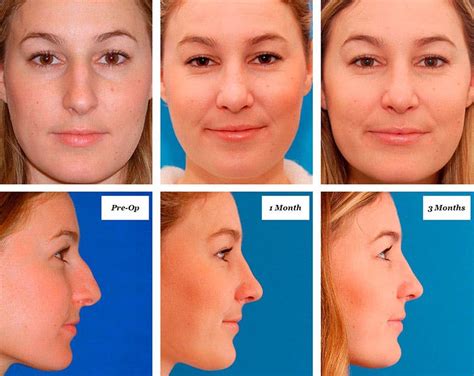 Optimizing Healing: A Comprehensive Guide to Gauze Changes in Rhinoplasty Recovery | Justinboey