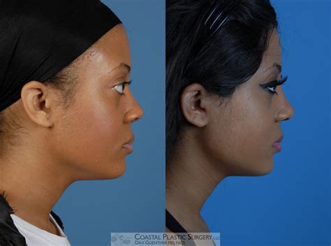 Rhinoplasty Before & After Photos Patient 3 | Boston, MA | Dax Guenther, MD: Coastal Plastic Surgery