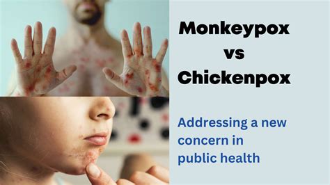 Monkeypox vs Chickenpox: Addressing a new concern in public health ...