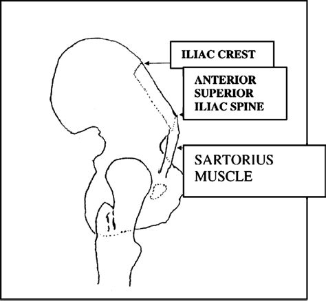 Anterior Superior Iliac Crest