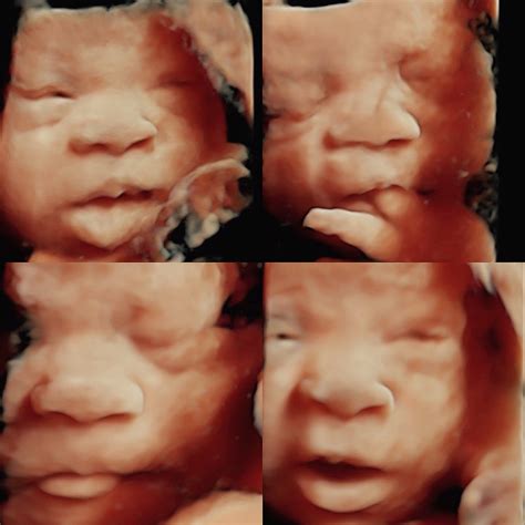 Why 3D/4D (HD/5D) Ultrasounds are Amazing!