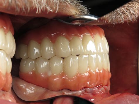 Temporary Full Implant Teeth. Why Do This Step? | Ramsey A. Amin, DDS