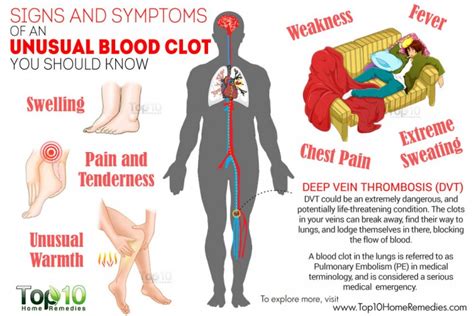 10 Signs & Symptoms of an Unusual Blood Clot You Should Know | Top 10 ...