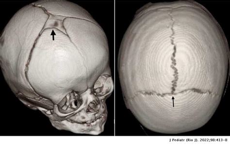 Anterior fontanelle closure and diagnosis of non-syndromic ...