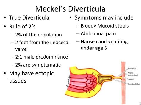 Diverticula of the Alimentary Tract Aaron Sinclair MD