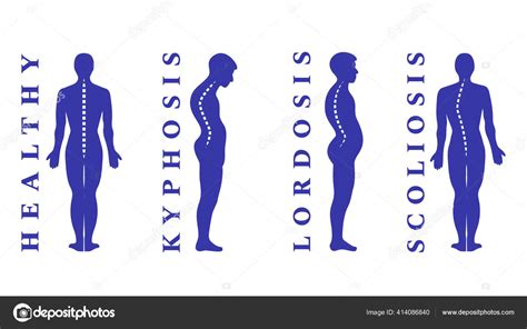 Diseases Spine Scoliosis Lordosis Kyphosis Body Posture Defects Back ...