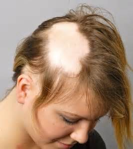 Alopecia Areata Treatment – Viva Healthy Life – The Center for Holistic ...