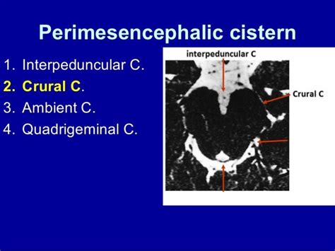 CSF cisterns
