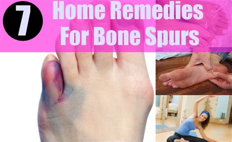 Top 7 Home Remedies For Bone Spurs - Natural Treatments And Cures For ...