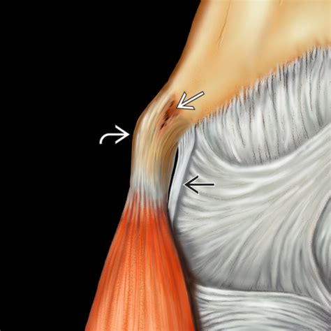 Elbow Epicondylitis | Radiology Key