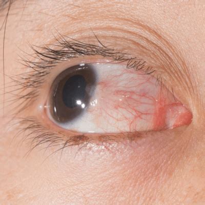 What is Pterygium: Symptoms, Treatments & Laser Surgery