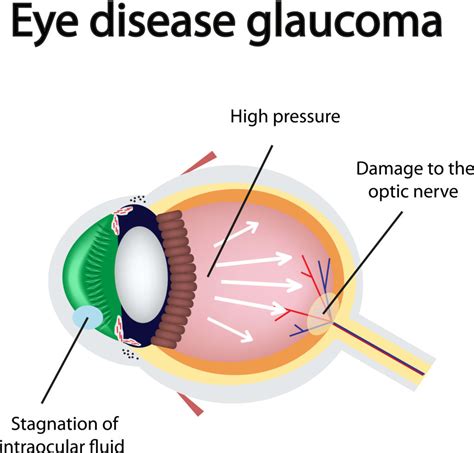 What is Glaucoma | Eye Associates of Tucson | Glaucoma Tucson - Eye ...