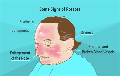 Flushing: Causes, Symptoms, and Treatment