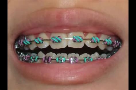 bloggingforfun6395: Different Colored Braces Bands