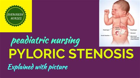 PYLORIC STENOSIS IN BABIES - YouTube