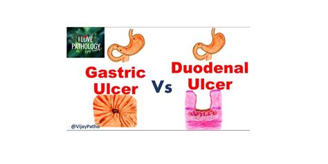 Duodenal Ulcer