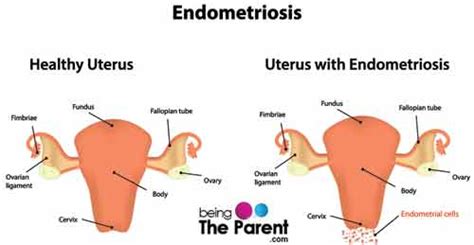 Cyst-in-Fallopian-Tube