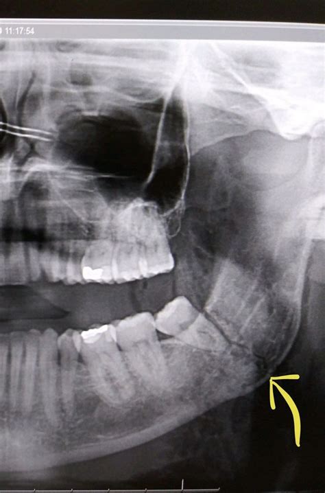 Finn Balor posts a graphic X-Ray image of his broken jaw, big update on his future