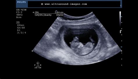 Ultrasound imaging: Fetal 3D-ultrasound images at 10 weeks