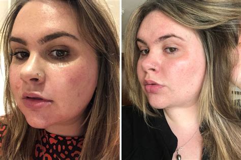 “I had hyaluronic acid injected into my face and this is what happened ...