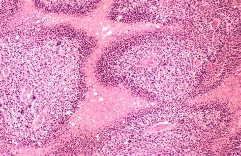 Glioblastoma Multiforme (GBM) - Stepwards