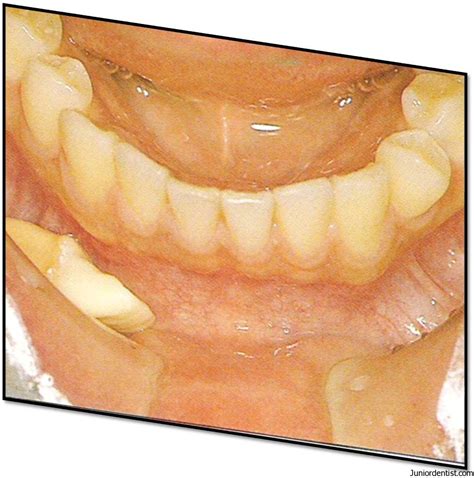 Tooth Avulsion - Exarticulation of Tooth | Treatment and Management