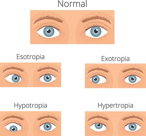 Strabismus: Fact Sheet - Vision Eye Institute