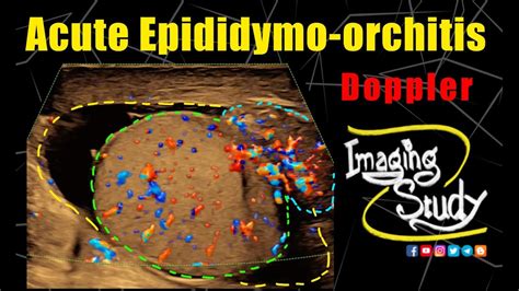 Acute Epididymo-orchitis || Ultrasound || Doppler || Case 326 - YouTube